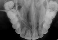 Oclusal Oclusal