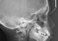 TeleRadLateral TeleRadLateral